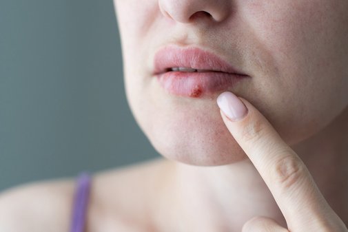 Nahaufnahme eines weibliches Gesichts, auf der Lippe ist ein rotes Lippenbläschen zu sehen, ein Finger fährt in Richtung des Bläschens.